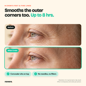 Before and after, crow's feet (illustration)