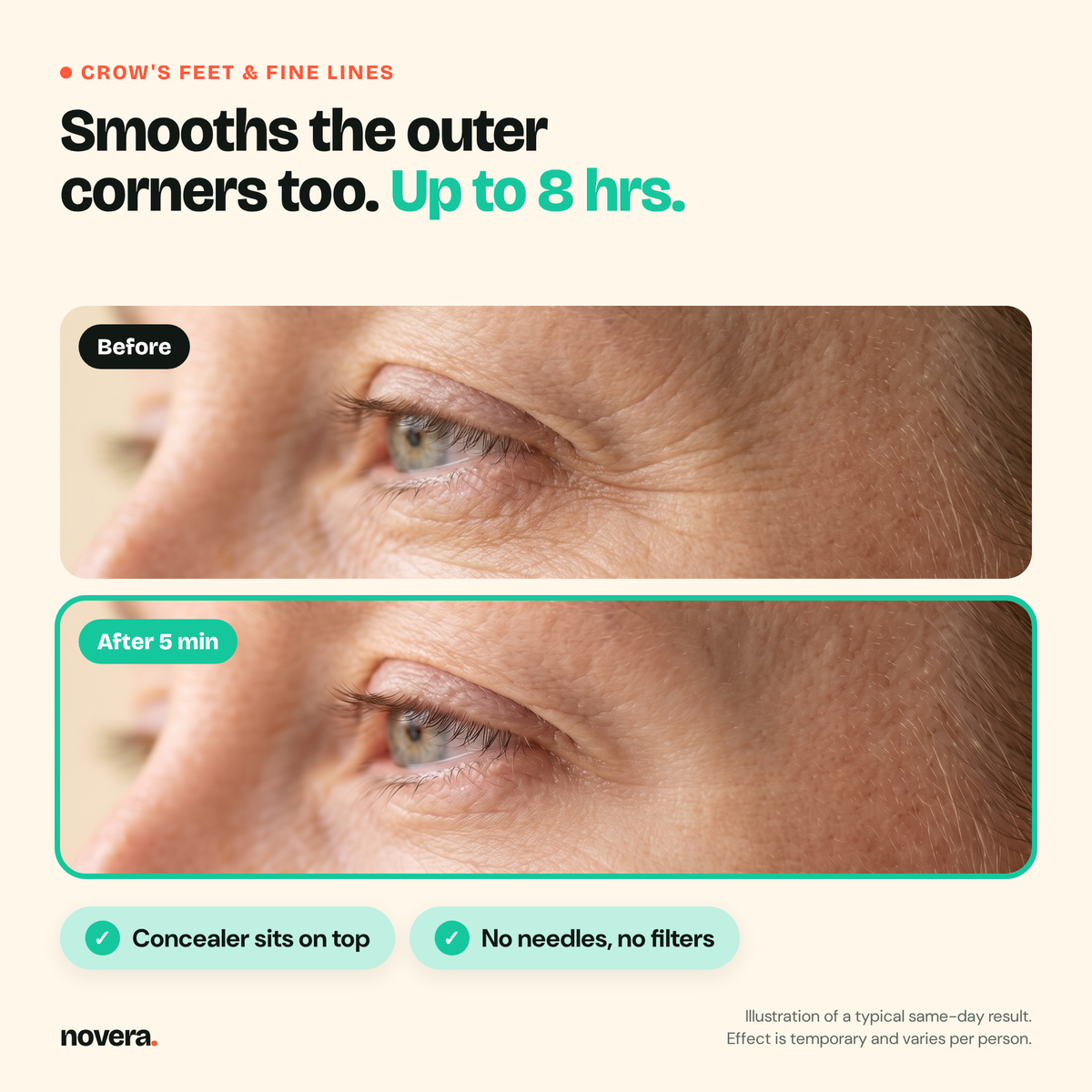 Before and after, crow's feet (illustration)